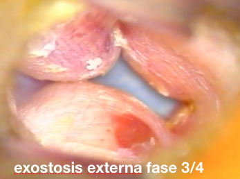 exostosis externa 3/4 | surfersoor